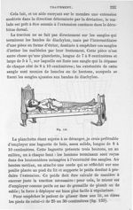 Fig. 133. [Adaptation du lit à l'appareil de traction continue] - Leçons cliniques sur la chirurgie  [...]