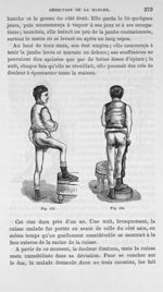 Fig. 155 et 156. [Malade opéré pour une coxalgie et remis] - Leçons cliniques sur la chirurgie ortho [...]