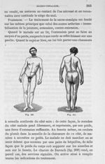 Fig. 163 et 164. [Cas de sacro-coxalgie] - Leçons cliniques sur la chirurgie orthopédique 