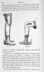 Fig. 181 et 182. [Nécrose de l'extrémité inférieure du fémur et ankylose du genou guéries] - Leçons  [...]