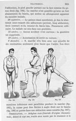 Fig. 185, 186 et 187. [Ankylose fibreuse de la hanche guérie] - Leçons cliniques sur la chirurgie or [...]
