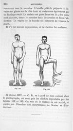 Fig. 192 et 193. [Ankylose fibreuse guérie] - Leçons cliniques sur la chirurgie orthopédique 