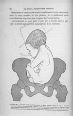 Figure 19 - L'ovoïde foetal se présentant par le siège complet, fesses et talons, attitude accroupie [...]