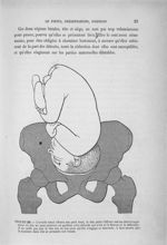 Figure 20 - L'ovoïde foetal offrant son petit bout, la tête, mais l'offrant mal au détroit supérieur [...]