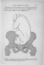 Figure 21 - Engagement du pôle foetal céphalique par le sommet. ... - Introduction à l'étude cliniqu [...]