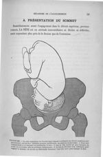 Figure 47 - Le pôle céphalique de l'ovoïde foetal disposé à présenter au détroit supérieur, soit son [...]