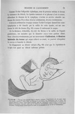 Figure 60 - Passage des épaules dans le détroit vulvaire. ... - Introduction à l'étude clinique et à [...]