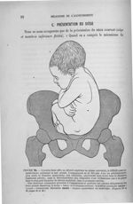 Figure 72 - L'ovoïde foetal offre au détroit supérieur sa grosse extrémité, le siège complet modérém [...]