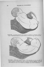 Figure 79 - La hanche antérieure ayant dépassé la symphyse, la postérieure a forcé le coccyx: ... /  [...]