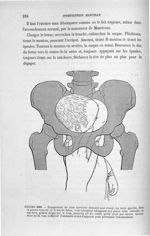 Figure 163 - Dégagement du bras antérieur demeuré seul relevé. ... - Introduction à l'étude clinique [...]