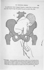 Figure 180 - Epaule droite, dorso - antérieure ... - Introduction à l'étude clinique et à la pratiqu [...]