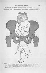 Figure 181 - Epaule droite, ... - Introduction à l'étude clinique et à la pratique des accouchements [...]