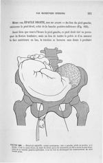Figure 185 - Epaule droite, ... - Introduction à l'étude clinique et à la pratique des accouchements [...]