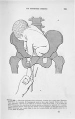 Figure 194 - Présentation de l'épaule gauche, dorso-antérieure. ... - Introduction à l'étude cliniqu [...]