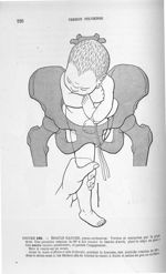 Figure 195 - Présentation de l'épaule gauche, dorso-antérieure. ... - Introduction à l'étude cliniqu [...]