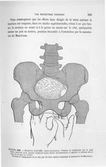 Figure 198 - Présentation de l'épaule gauche, dorso-antérieure. Version et extraction par le pied dr [...]