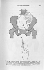 Figure 233 - Epaule gauche, dorso-postérieure. Version et extraction par le bon pied, le droit. ...  [...]