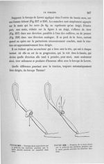 Figure 257 - Traction de la main droite sur le pédicule des cuillères pendant que la main gauche sou [...]