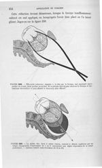 Figure 359 - Effroyable réduction imposée à la tête par le forceps mal appliqué: place perdue en ava [...]