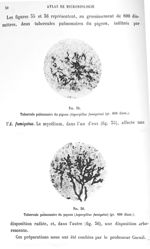 Fig. 35. Tubercule pulmonaire du pigeon (aspergillus fumigatus) (gr. 800 diam.) / Fig. 36. Tubercule [...]