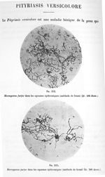 Fig. 212. Microsporon furfur dans les squames épidermiques (méthode de Gram) (gr. 200 diam.) / Fig.  [...]