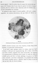 Fig. 255. Actinomycose de l'homme. Grain préparé par écrasement (gr. 200 diam.). - Atlas de microbio [...]