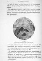 Fig. 265. Rein de bœuf. Actinomycose (gr. 60 diam.) (Nocard). - Atlas de microbiologie par E. Doyen  [...]
