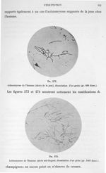 Fig. 273. Actinomycose de l'homme (abcès de la joue), dissociation d'un grain (gr. 800 diam.) / Fig. [...]