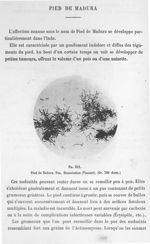Fig. 311. Pied de Madura. Pus. Dissociation (Vincent) (gr. 700 diam.). - Atlas de microbiologie par  [...]