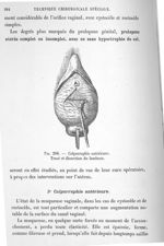 Fig. 206. Colporraphie antérieure. Tracé et dissection du lambeau - Technique chirurgicale par E. Do [...]