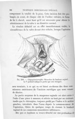 Fig. 209. Colpopérinéorraphie. Dissection du lambeau vaginal. Le V profond indique la partie qui ser [...]