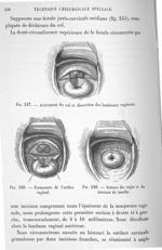 Fig. 247. Avivement du col et dissection des lambeaux vaginaux / Fig. 248. Fermeture de l'orifice va [...]
