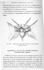 Fig. 373. Extraction et dissection de l'utérus en deux moitiés d'arrière en avant - Technique chirur [...]