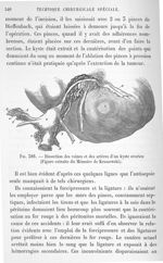 Fig. 386. Dissection des veines et des artères d'un kyste ovarien - Technique chirurgicale par E. Do [...]
