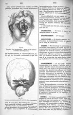 Fig. 437. Dissection d'une encéphalocèle. Hernie du lobe antérieur du cerveau (Musée Dupuytren / Fig [...]