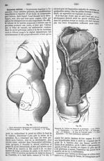 Fig. 554. Paroi abdominale distendue par le fait de la grossesse / Fig. 555. Rapports de l'utérus au [...]