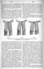 Fig. 558 / Fig. 559 / Fig. 560. Figures indiquant la perméabilité graduelle du col de l'utérus ches  [...]