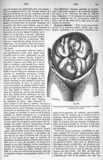 Fig. 561. Grossesse gémellaire (l'un des foetus se présente par le sommet et l'autre par le siège) - [...]
