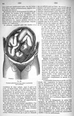 Fig. 562. Grossesse gémellaire (les deux foetus se présentent par le sommet) - Dictionnaire populair [...]