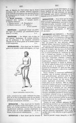 Fig. 600. Monstre hétéradelphe (Ambroise Paré) - Dictionnaire populaire de médecine usuelle. tome 2