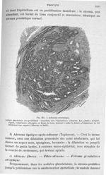 Fig. 398. Adénome prostatique (Albarran et Hallé). - Manuel d'histologie pathologique, par V. Cornil [...]