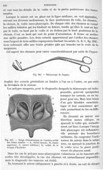 Fig. 261. Rhinoscope de Duplay/  Fig. 262. Image rhinoscopique de l'arrière-cavité des fosses nasale [...]