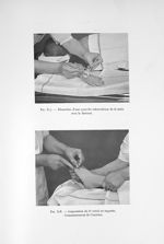 Fig. 317. Dissection d'une synovite tuberculeuse de la main avec le bistouri / Fig. 318. Amputation  [...]