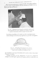 Fig. 24. Extirpation d'une loupe du cuir chevelu. Incision de la peau et dissection de la lèvre supé [...]