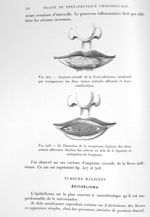 Fig. 407. Angiome cirsoïde de la lèvre inférieure, montrant par transparence les deux troncs artérie [...]
