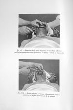 Fig. 535. Résection de la partie moyenne du maxillaire inférieur par l'incision sous-maxillaire hori [...]