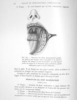 Fig. 592. Dissection du sillon glosso-gingival gauche. Au fond le nerf lingual, entre l'amygdale et  [...]