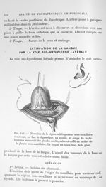 Fig. 626. Dissection de la région sublinguale et sous-maxillaire montrant, en bas, le digastrique; a [...]