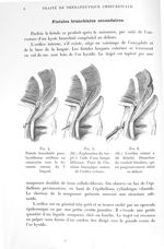 Fig. 4. Fistule branchiale para-hyoïdienne médiane en connexion avec le foramen caecum du V lingual  [...]