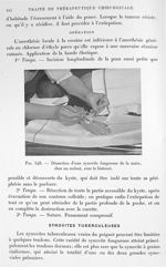 Fig. 548. Dissection d'une synovite fongueuse de la main, chez un enfant, avec le bistouri. - Traité [...]